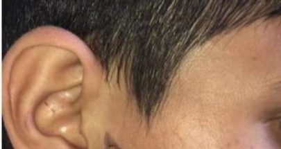 scarsss-405x215