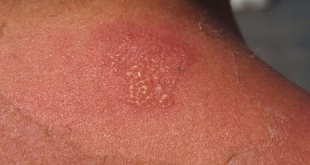sunburn